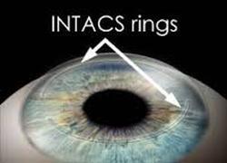 Intacs Picture